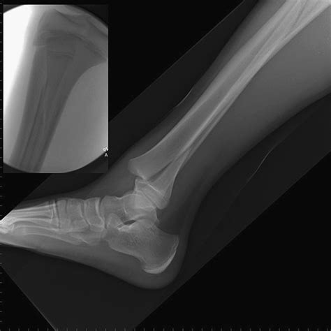 High Fibular Fracture In Association With Triplane Fracture