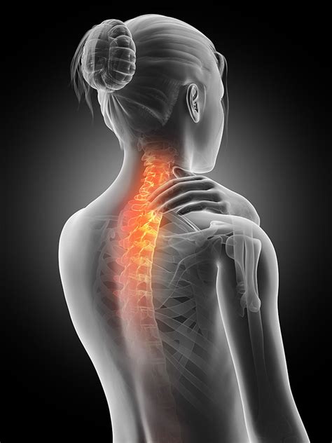 Pinched Nerve In Neck Trapped Compressed Nerve In Your Neck Physio
