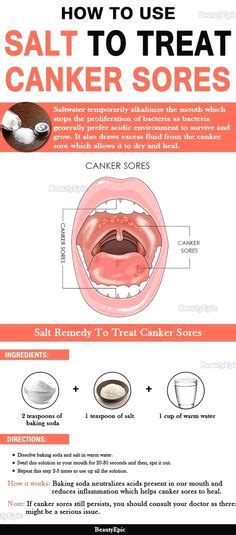 9 Best Sores On Roof Of Mouth Images Mouth Sores Remedies Cold Sore
