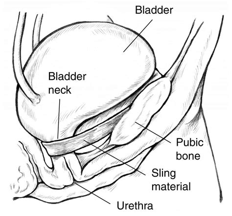 Mesh Sling Procedure For Stress Urinary Incontinence In Women Preop Hot Sex Picture