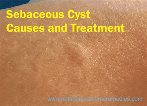 Sebaceous Cysts Causes And Treatment Before They Get Infected