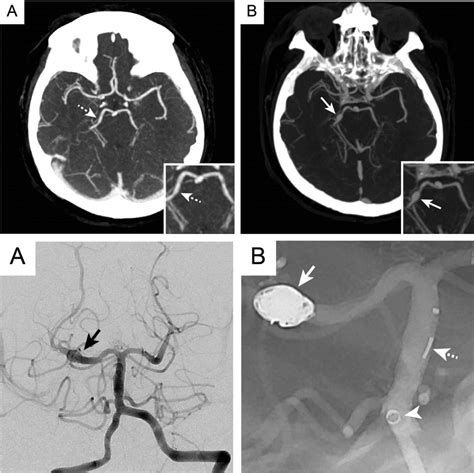 E 045 Cerebral Vascular Findings In Papa Syndrome Cerebral Arterial