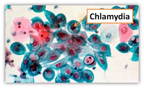 Common Warning Signs Of Chlamydia