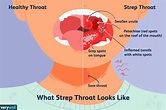 Strep Throat: Causes, Symptoms, Treatment, and More