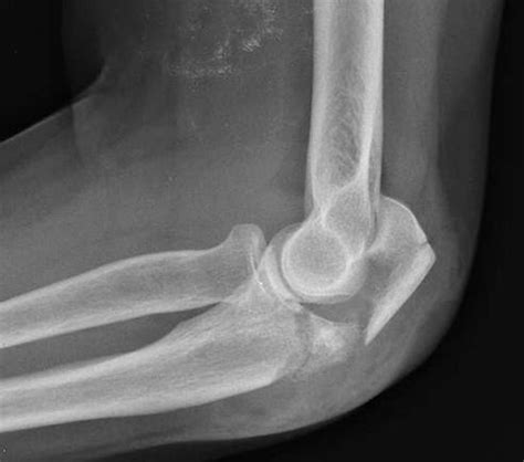 Non Surgical Functional Treatment For Displaced Olecranon Fractures In