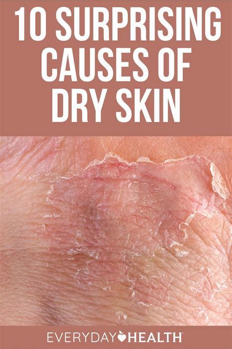 10 Surprising Causes Of Dry Skin Everyday Health Dry Itchy Skin