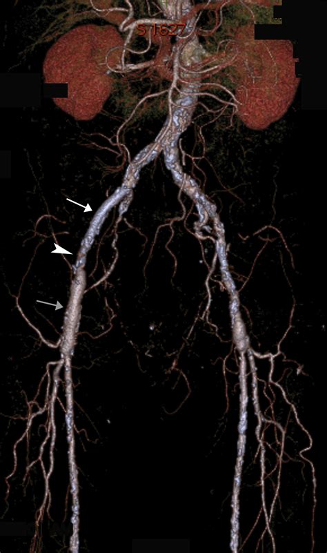 Iliac Artery Stenting Combined With Open Iliofemoral Endarterectomy