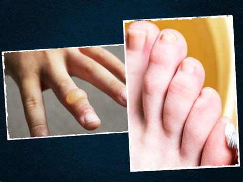 How To Treat A Burn Blister Try These Effective Remedies Onlymyhealth