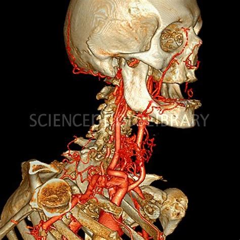 Neck And Head Arteries 3d Angio Ct Scan Visual Library Pinterest 3d