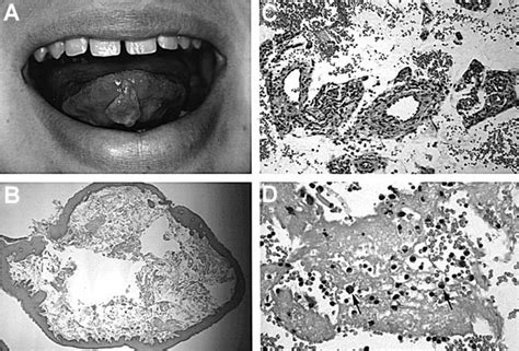 Mucocele Of The Anterior Lingual Salivary Glands Glands Of Blandin And