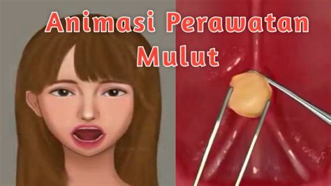 Asmr Animasi Perawatan Mulut Mengeluarkan Batu Kelenjar Ludah Youtube