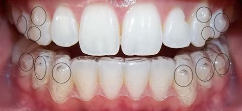 ¿qué Son Los Ataches En Invisalign Clínica Dental Trejo