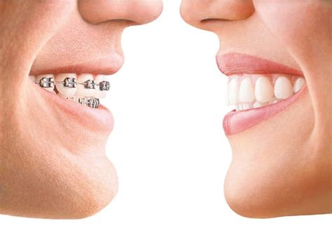 Comparing Braces And Invisalign The Pros And Cons Ooli Orthodontics