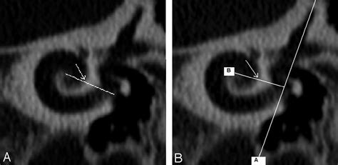 Ct And Mr Imaging Cochlear Distance Measurements May Predict Cochlear