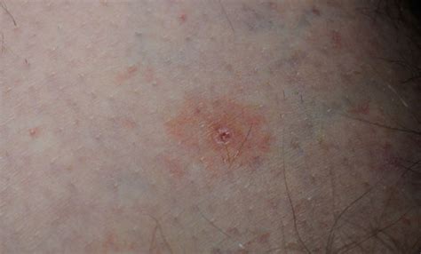 What Does A Tick Bite Look Like What Does It Look Like Find Out Here