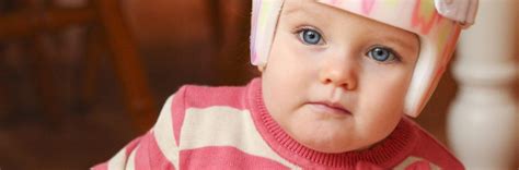 Incidence Of Plagiocephaly In Infants As High As 466