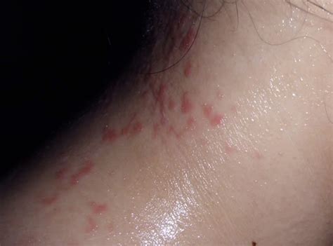 Itchy Neck Pictures Symptoms Treatment Rash Causes 2018 Updated