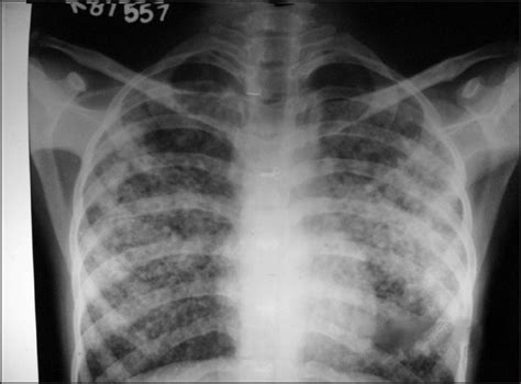 Pulmonary Edema X Ray Acute Pulmonary Edema Image