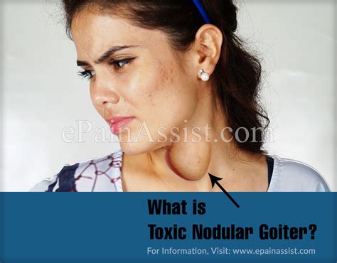 Toxic Nodular Goiter Or Plummer Disease Causes Symptoms