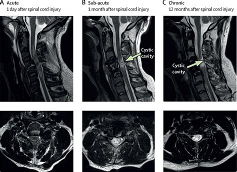 Mri In Traumatic Spinal Cord Injury From Clinical Assessment To