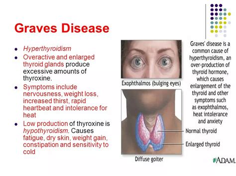 Diagnosing Graves Disease Signs Symptoms And Tests Hendrxhealth