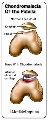 Images of Patellofemoral Chondromalacia Treatment