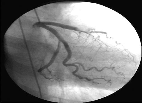Spontaneous Coronary Artery Dissection Emergency Medicine Journal