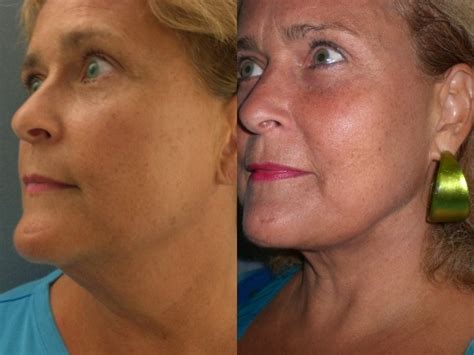 Before And After Laser Lipo On The Chin And Jowls With The Smart Lipo
