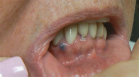 Breakthrough Clinical Oral Pathology Case No 36 Dentistryiq