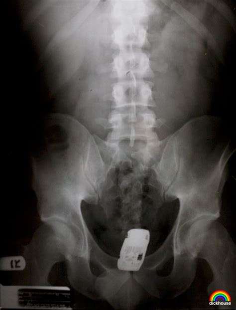 real xrays of things stuck up peoples butts sports hip hop and piff the coli