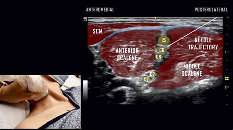 Interscalene Block Ultrasound Anatomy Review Youtube
