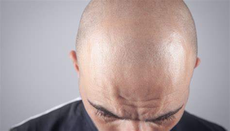 Is A Bald Man Really Hairless Explain
