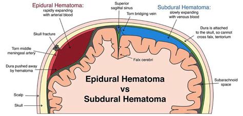 Epidural Hematoma Vs Subdural Hematoma Medizzy