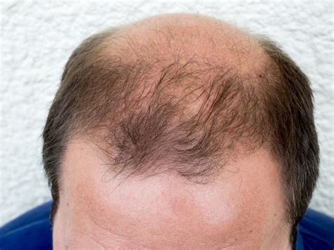 Pattern Baldness Causes Symptoms And Treatments Justinboey