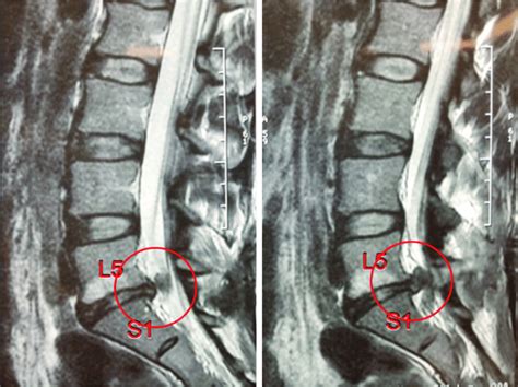 Recurrent Disc Herniation L5s1 With Modic Endplate Changes And Loss Of