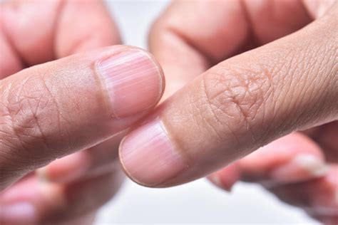 Ridges In Fingernails What It Means If You Have Them The Healthy
