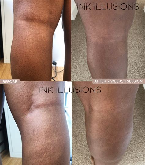 Inkless Stretch Mark And Scar Tattoo Camouflage Treatment Ink Illusions