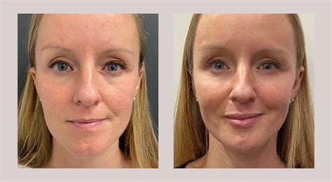 Before And After Photo Facial Filler Md Beauty Clinic Blog