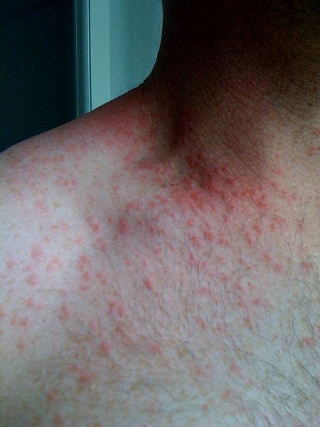 Symptoms Of Pityrosporum Folliculitis Animal Skin Disorder