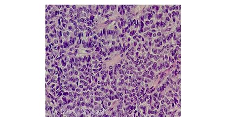Granulosa Cell Tumor Ovary Pathology Made Simple
