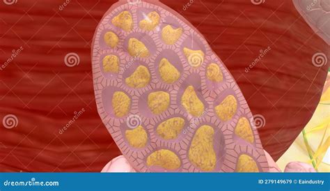 The Lobular Carcinoma In Situ Stock Illustration Illustration Of