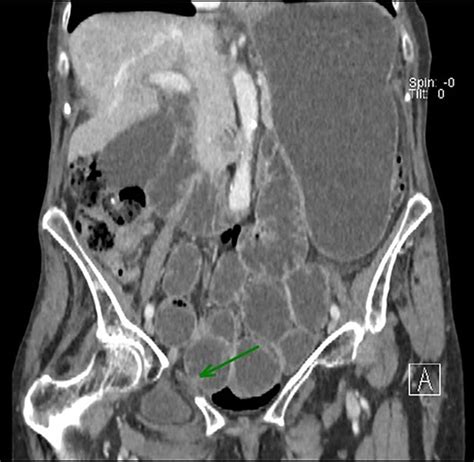 Diagnosis Of An Obturator Hernia By CT BMJ Case Reports