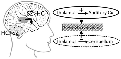 Schizophrenia Auditory Hallucinations