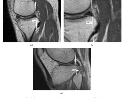 Passive Posterior Tibial Subluxation On Routine Knee Mri As A Secondary