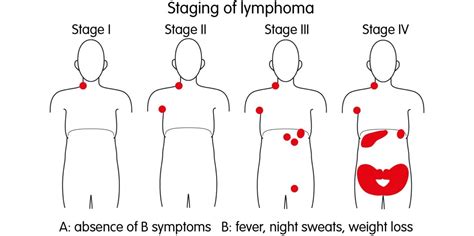 Hodgkins Lymphoma Statistics Symptoms And Treatment