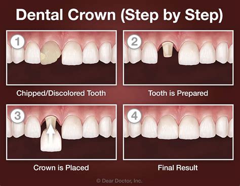 Crowns And Bridgework Fall Creek Dental Granbury Texas