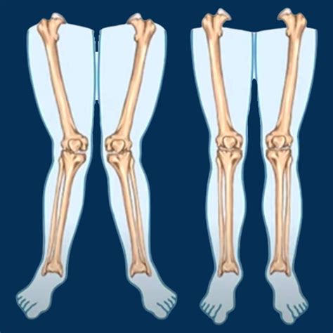 Knock Knee Deformity Causes Symptoms Diagnosis And Treatment