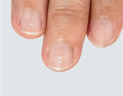 5 Things You Can Learn From Your Fingernailsratemds Health News