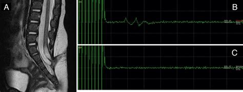 Case 13 A Female 3 Months Of Age Was Diagnosed With Limited Dorsal