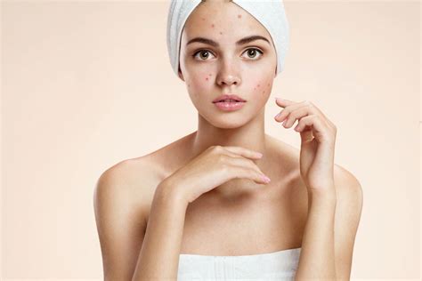 Acne Treatments For All Skin Types